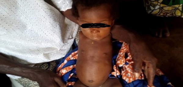 Au Togo, une fillette naît sans bras Au Togo, une fillette naît sans bras