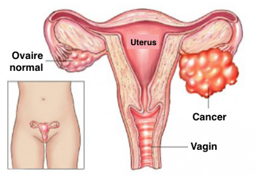 Vous doublez votre risque de cancer des ovaires en faisant ceci