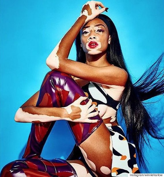 Vitiligo, la maladie bizarre qui vous dépigmente la peau Vitiligo, la maladie bizarre qui vous dépigmente la peau