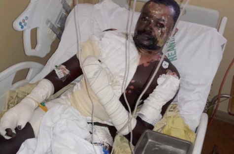 Sa femme lui verse de l'huile chaude et s'enfuit, Babacar Mbaye entre la vie et la mort (images) Sa femme lui verse de l'huile chaude et s'enfuit, Babacar Mbaye entre la vie et la mort (images)