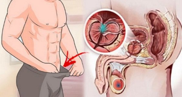 12 symptômes avant-coureurs du cancer de la prostate que tous les hommes doivent connaître ! Ne les ignorez pas. 12 symptômes avant-coureurs du cancer de la prostate que tous les hommes doivent connaître ! Ne les ignorez pas.