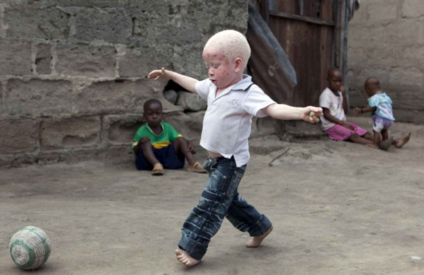Élection législative de juillet prochain: La grande peur des albinos Élection législative de juillet prochain: La grande peur des albinos
