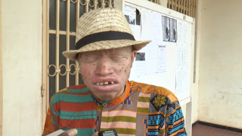 Ziguinchor : A quelques jours des élections législatives, les albinos réclament la protection de l’Etat Ziguinchor : A quelques jours des élections législatives, les albinos réclament la protection de l’Etat