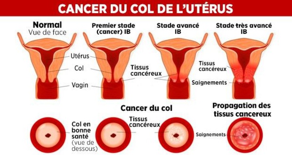Cancer du col de l’utérus : « Chaque année, le Sénégal enregistre 875 cas », selon la Lisca Cancer du col de l’utérus : « Chaque année, le Sénégal enregistre 875 cas », selon la Lisca