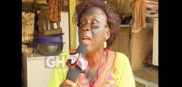 Ghana: Elle perd la vue dans ses tentatives de se blanchir la peau Ghana: Elle perd la vue dans ses tentatives de se blanchir la peau