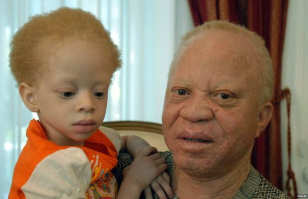 Djéneba Diarra Une jeune albinos assassinée et son corps décapité à l’approche des élections Djéneba Diarra Une jeune albinos assassinée et son corps décapité à l’approche des élections