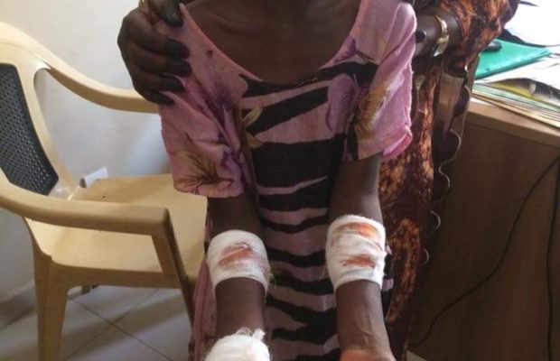 Orpheline de père et de mère cette pauvre en classe de CP a été brûlée par sa tante Orpheline de père et de mère cette pauvre en classe de CP a été brûlée par sa tante
