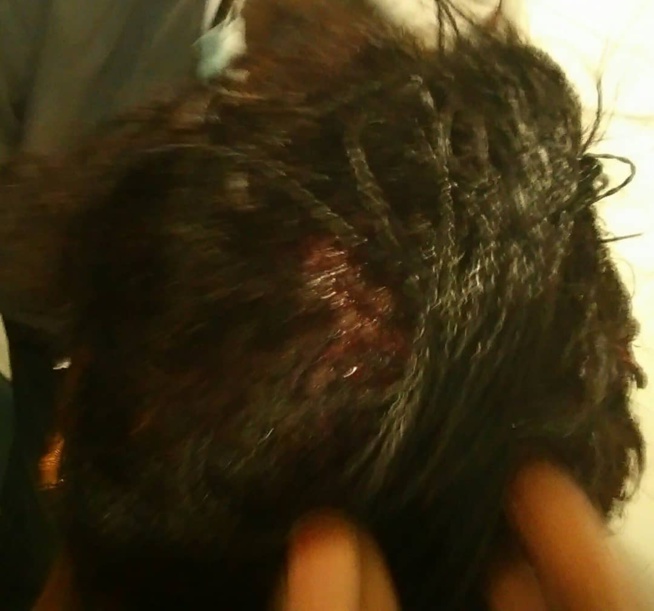 âmes sensibles s’abstenir ) Veille de sa nuit de noces: Oumou Diop attaquée à coups de hache par sa co-épouse Salimata âmes sensibles s’abstenir ) Veille de sa nuit de noces: Oumou Diop attaquée à coups de hache par sa co-épouse Salimata