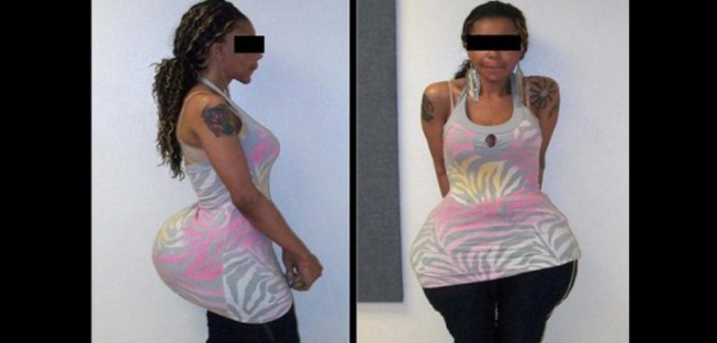 Des injections de silicone dans les fesses paralysent un mannequin