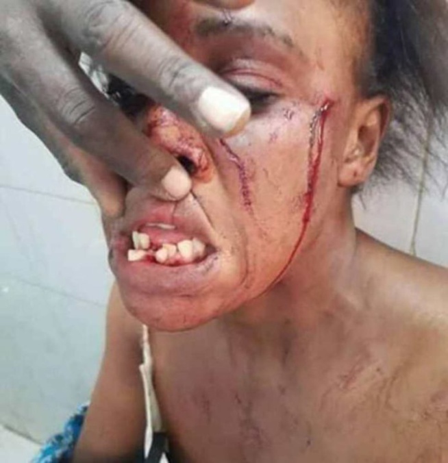 Touba : Une dame charcute et édente sa co-épouse Touba : Une dame charcute et édente sa co-épouse