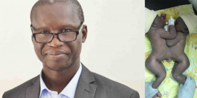 Pr. Gabriel Ngom: « Comment j’ai séparé les deux sœurs collées à la naissance » Pr. Gabriel Ngom: « Comment j’ai séparé les deux sœurs collées à la naissance »