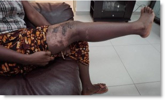 Une femme ébouillante sa co-épouse Mame Awa NDAO , à Koungheul Une femme ébouillante sa co-épouse Mame Awa NDAO , à Koungheul