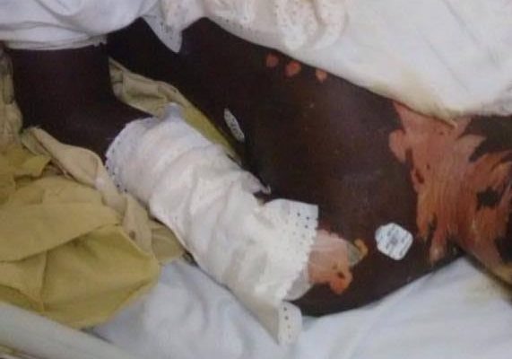Scandale à Matam: Après avoir aspergé son ami d’acide sulfurique bouillant, il sort de prison sans êtres jugé Scandale à Matam: Après avoir aspergé son ami d’acide sulfurique bouillant, il sort de prison sans êtres jugé