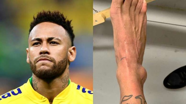 ( Photos ) Brésil : Neymar publie une photo de sa cheville après sa blessure