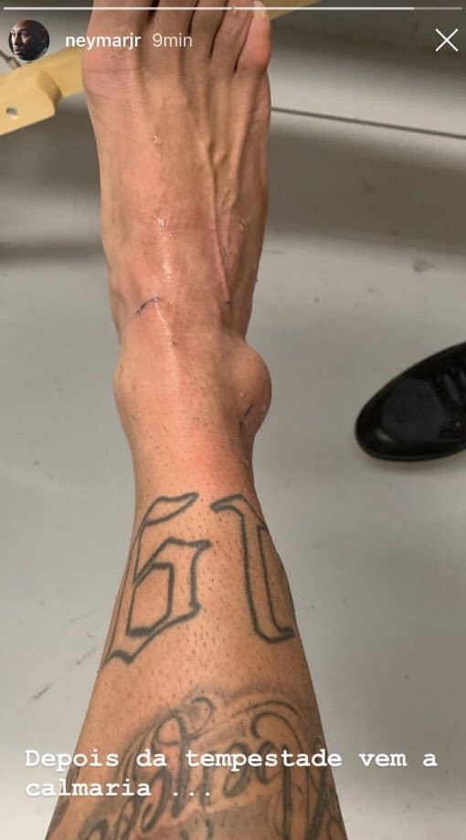 ( Photos ) Brésil : Neymar publie une photo de sa cheville après sa blessure ( Photos ) Brésil : Neymar publie une photo de sa cheville après sa blessure