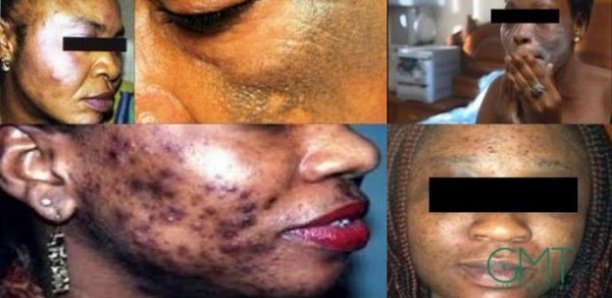 Dépigmentation au Sénégal: Le taux n'est pas de 71,3 % Dépigmentation au Sénégal: Le taux n'est pas de 71,3 %