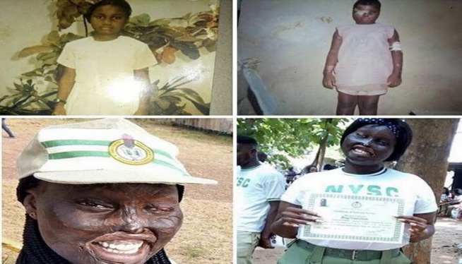 Défigurée à l’acide par l’épouse de son oncle, elle raconte son histoire Défigurée à l’acide par l’épouse de son oncle, elle raconte son histoire