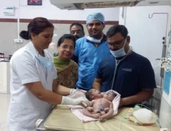 Inde: Une femme donne naissance à des «jumeaux siamois rares» Inde: Une femme donne naissance à des «jumeaux siamois rares»