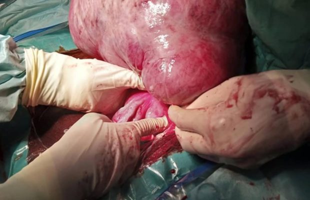 Photos: fibrome de dix kilogrammes retiré d’une dame à Thiès