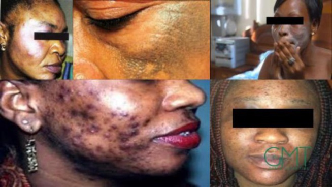 Dépigmentation: Au-delà d’une simple interdiction de la publicité Dépigmentation: Au-delà d’une simple interdiction de la publicité