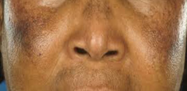 Dépigmentation : Des hommes sont entrés dans la danse Dépigmentation : Des hommes sont entrés dans la danse