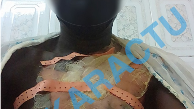 Fait divers à Touba : Le tailleur Amath Diallo ébouillanté par son épouse échappe de justesse à la mort (Photo) Fait divers à Touba : Le tailleur Amath Diallo ébouillanté par son épouse échappe de justesse à la mort (Photo)