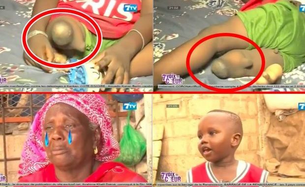 Rufisque : Triste histoire de Bébé Mouhamed (3ans) né avec une seule jambe Rufisque : Triste histoire de Bébé Mouhamed (3ans) né avec une seule jambe
