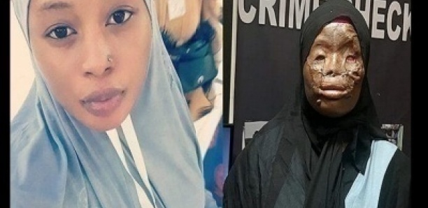 Arabie Saoudite: Une Ghanéenne victime d’une attaque à l’acide