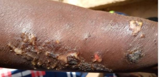 Maladie mystérieuse: les femmes de Ndayane ont trouvé le "vaccin", en deux jours, on... Maladie mystérieuse: les femmes de Ndayane ont trouvé le "vaccin", en deux jours, on...