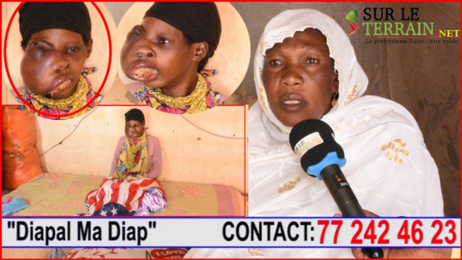 SOS Rokhaya Béye ;Atteinte d’une tumeur Faciale ses parents sollicitent l’aide de la Première Dame et de tout…