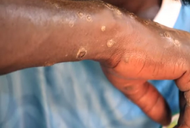 Maladie des pêcheurs : « Une contamination chimique ponctuelle, pas un effet viral ou dû aux algues» Brahima Cissé, de Greenpeace Afrique Maladie des pêcheurs : « Une contamination chimique ponctuelle, pas un effet viral ou dû aux algues» Brahima Cissé, de Greenpeace Afrique