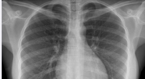 DR BOUSSO ALERTE SUR DES COMPLICATIONS LIÉES À DES SÉQUELLES PULMONAIRES DR BOUSSO ALERTE SUR DES COMPLICATIONS LIÉES À DES SÉQUELLES PULMONAIRES