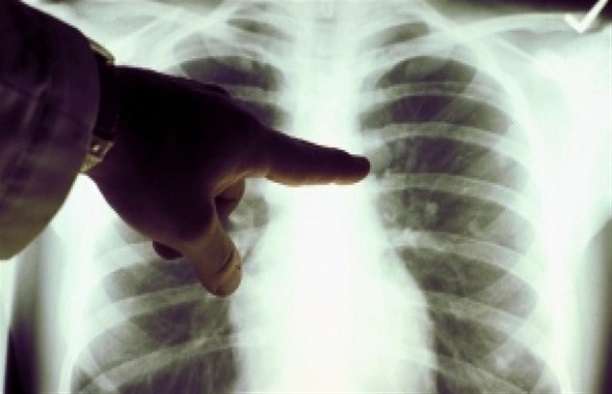 Santé-Elimination de la tuberculose en 2035 : l’Etat mise sur la prise en charge des cas contagieux Santé-Elimination de la tuberculose en 2035 : l’Etat mise sur la prise en charge des cas contagieux