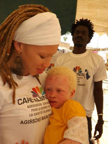 Le groupe Takeifa soutient les Albinos
