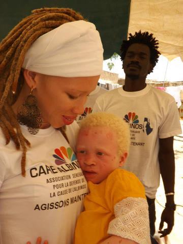 Le groupe Takeifa soutient les Albinos Le groupe Takeifa soutient les Albinos