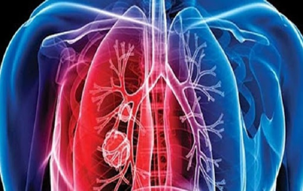 Autre danger pour la santé publique : pourtant la tuberculose continue de tuer au Sénégal Autre danger pour la santé publique : pourtant la tuberculose continue de tuer au Sénégal