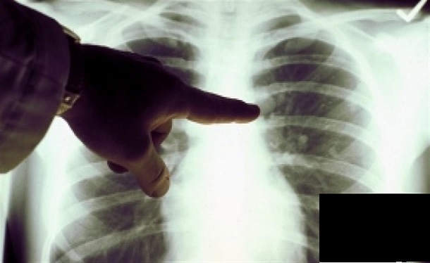 Tuberculose, Dakar tousse :au Sénégal, 44% des cas de tuberculose se trouvent dans la capitale Tuberculose, Dakar tousse :au Sénégal, 44% des cas de tuberculose se trouvent dans la capitale