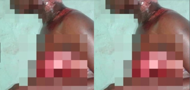 Parcelles assainies: Une domestique ébouillante sa voisine Parcelles assainies: Une domestique ébouillante sa voisine