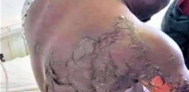 Accusé de déféquer dans sa maison: Un talibé de 8 ans ébouillanté par une étudiante togolaise Accusé de déféquer dans sa maison: Un talibé de 8 ans ébouillanté par une étudiante togolaise