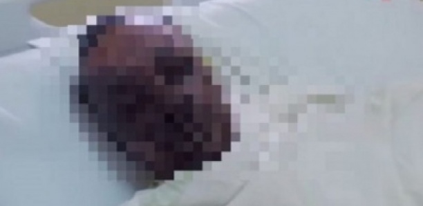 Grand Yoff : larguée, une fille ébouillante son ex petit ami Grand Yoff : larguée, une fille ébouillante son ex petit ami