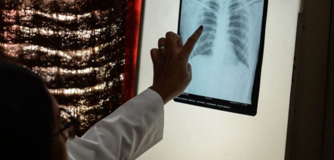 Tuberculose: Diourbel est la deuxième région la plus touchée du Sénégal Tuberculose: Diourbel est la deuxième région la plus touchée du Sénégal