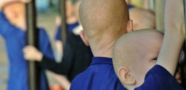 Burundi : Un enfant albinos tué et démembré Burundi : Un enfant albinos tué et démembré