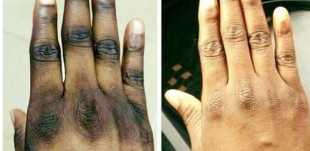 Pratique de la dépigmentation : Le Sénégal classé 2e pays africain derrière la Rdc Pratique de la dépigmentation : Le Sénégal classé 2e pays africain derrière la Rdc