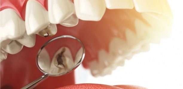 Santé bucco-dentaire : "Combattre les affections bucco-dentaires dans le cadre de la lutte contre les maladies non transmissibles" (OMS)