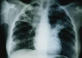 ALERTE - 336 cas de tuberculose enregistrés en 2013 á Kolda