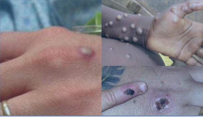 Ce qu’il faut savoir sur l’épidémie de variole du singe et ses différents modes de propagation Ce qu’il faut savoir sur l’épidémie de variole du singe et ses différents modes de propagation