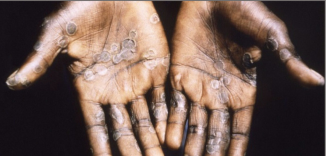 Variole du singe : 1.600 cas confirmés dans le monde, dont 72 décès (Oms) Variole du singe : 1.600 cas confirmés dans le monde, dont 72 décès (Oms)