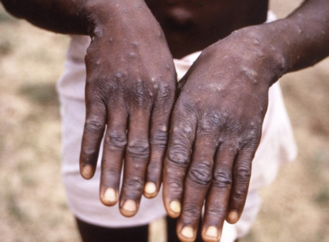 Variole du singe : l’Afrique doit miser sur le dépistage (OMS)