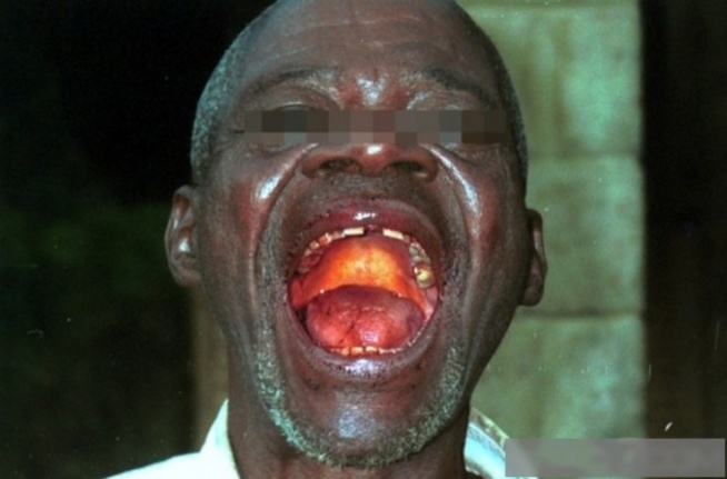 La fièvre Ebola fait 126 morts sur 206 cas en Guinée La fièvre Ebola fait 126 morts sur 206 cas en Guinée