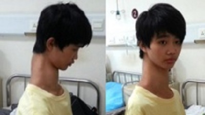 Le '’garçon girafe’', un jeune Chinois au cou anormalement long